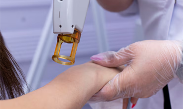 Laser Hair Removal in Markham